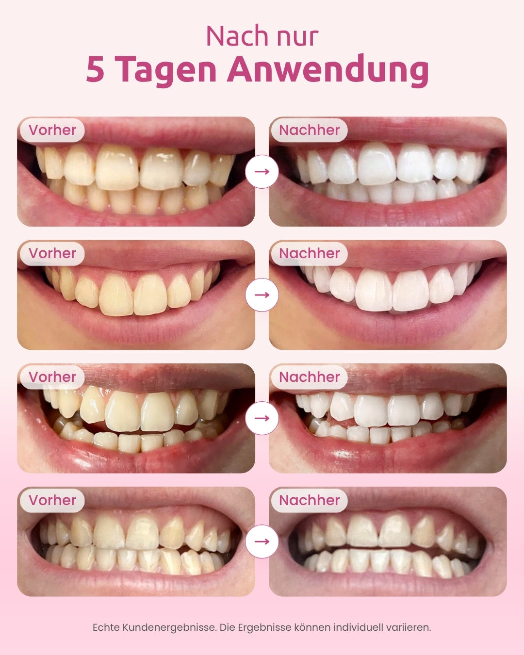 Resultados antes e depois de clientes após a utilização do kit de branqueamento dentário OnlySmile