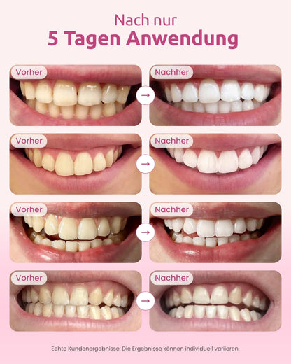 Resultados antes e depois de clientes após a utilização do kit de branqueamento dentário OnlySmile